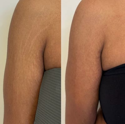 Close-up of a softened surgical scar after paramedical pigment camouflage treatment